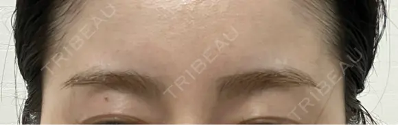 ボトックス（エラ・小顔） / ボトックス（肩） / シワ取りボトックス フォンタナクリニック天神 DAY 7 メイン用