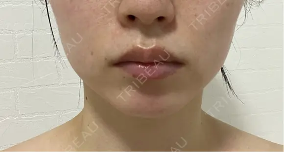 ボトックス（エラ・小顔） / ボトックス（肩） / シワ取りボトックス フォンタナクリニック天神 DAY 7 メイン用