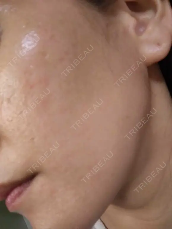 肌育注射（ジュベルックなど） メディカルアルファクリニック AFTER メイン用