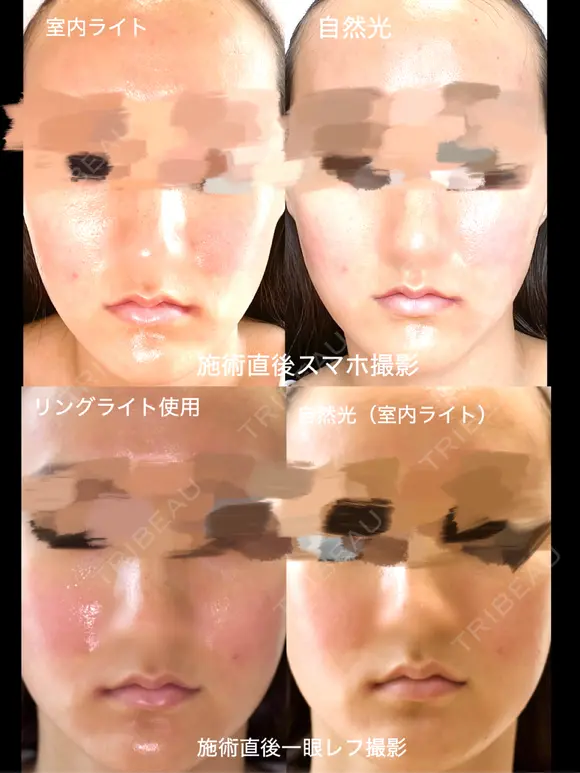 ヴァンパイアフェイシャル 東京美容クリニック 表参道本院 DAY 0 メイン用