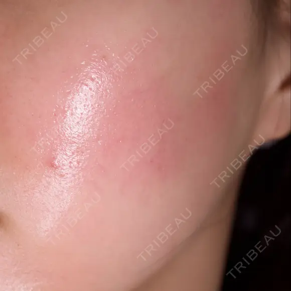 ヴァンパイアフェイシャル 東京美容クリニック 表参道本院 DAY 0 メイン用