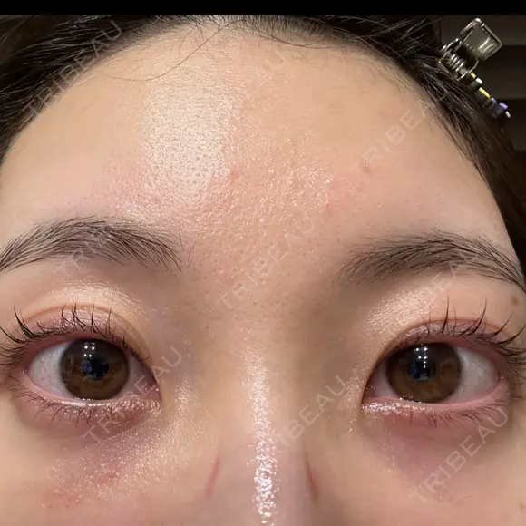 クマ治療 / 下まぶたの脂肪取り APOLLO BEAUTY CLINIC DAY 12 メイン用