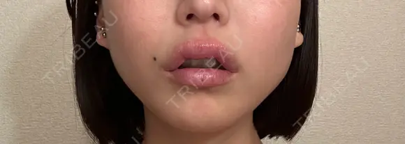 アートメイク（唇） 表参道メディカルクリニック 名古屋院 DAY 16 メイン用