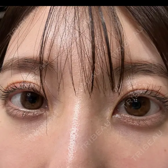 クマ治療 / 下まぶたの脂肪取り APOLLO BEAUTY CLINIC DAY 18 メイン用