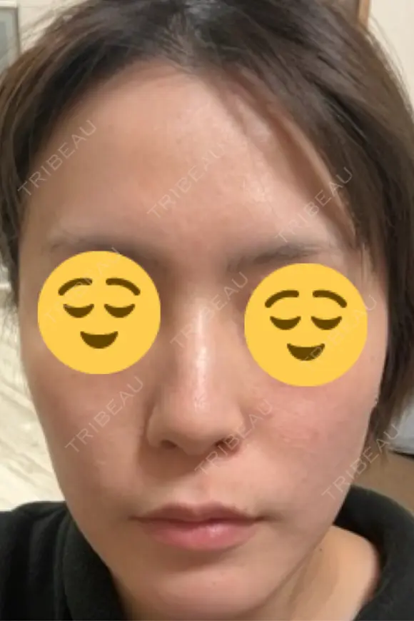 光治療（フォトフェイシャルなど） メディカルアルファクリニック DAY 7 メイン用