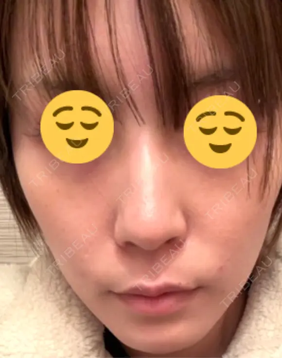 光治療（フォトフェイシャルなど） メディカルアルファクリニック DAY 10 メイン用