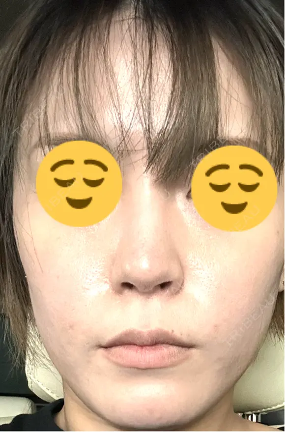 光治療（フォトフェイシャルなど） メディカルアルファクリニック DAY 12 メイン用