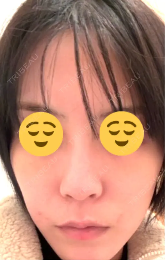 光治療（フォトフェイシャルなど） メディカルアルファクリニック AFTER メイン用