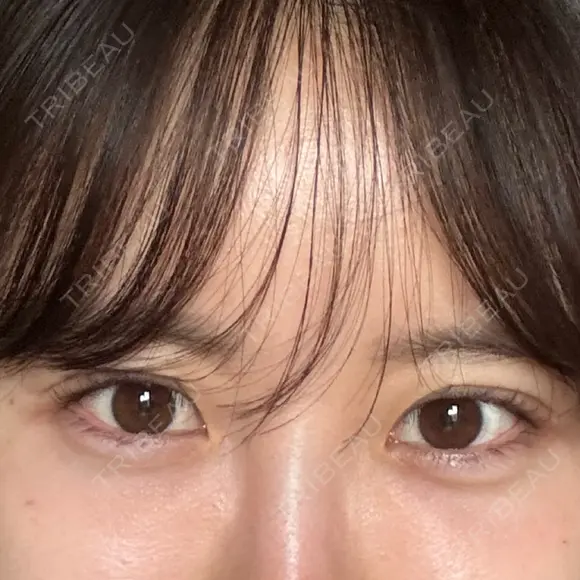 ヒアルロン酸注入（唇） / ヒアルロン酸注入（目の下） ROOTS Clinic DAY 0 メイン用