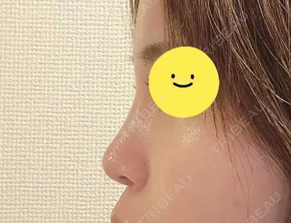 小鼻縮小（切開） / その他（鼻） EMMO FACE CLINIC 東京三田院 DAY 10 メイン用
