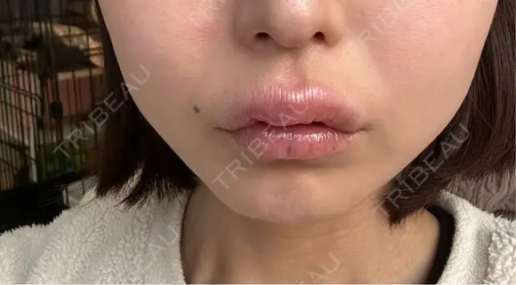 アートメイク（唇） 表参道メディカルクリニック 名古屋院 DAY 23 メイン用