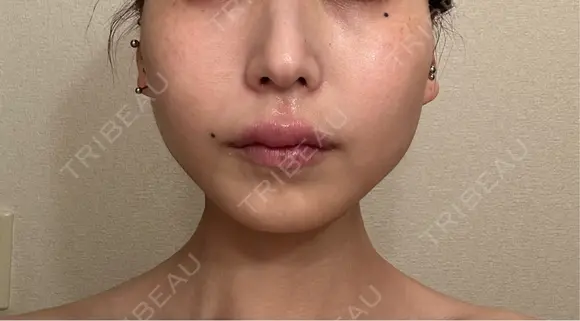 アートメイク（唇） 表参道メディカルクリニック 名古屋院 AFTER メイン用