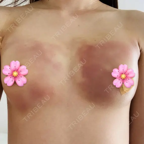 豊胸（脂肪注入） 湘南美容クリニック 吉祥寺院 DAY 1 メイン用