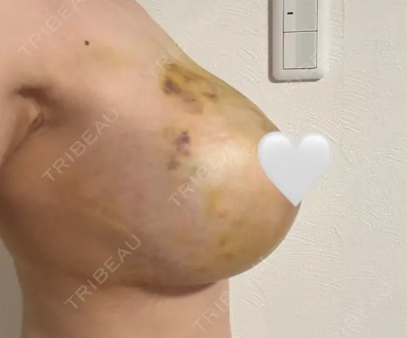 脂肪吸引（二の腕） / 脂肪吸引（脚） / 豊胸（シリコンバッグ） / 豊胸（脂肪注入） / 胸修正 / 豊胸（シリコン＋脂肪併用） ヴェルトラクリニック 新宿院 DAY 6 メイン用