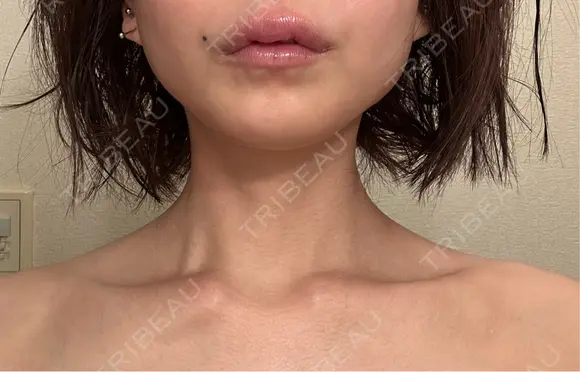 ボトックス（肩） ルラ美容クリニック 名古屋本院 DAY 5 メイン用