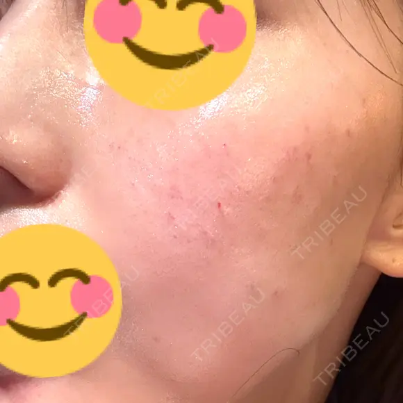 肌育注射（ジュベルックなど） シェリークリニック 福岡院 DAY 0 メイン用