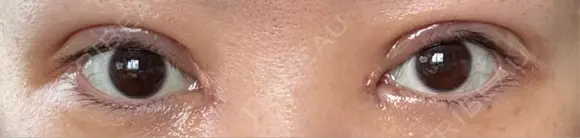 二重切開 / 目頭切開 / 眼瞼下垂（切開） EMMA CLINIC（エマクリニック） DAY 3 メイン用