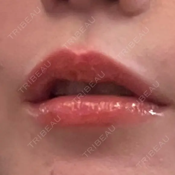 肌ヒアルロン酸注入（たるみ・シワ改善） / ボトックス（口角） / ボトックス（人中） S-Laboクリニック 渋谷院 DAY 1 メイン用