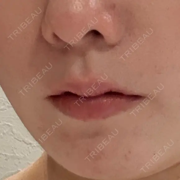 肌ヒアルロン酸注入（たるみ・シワ改善） / ボトックス（口角） / ボトックス（人中） S-Laboクリニック 渋谷院 AFTER メイン用