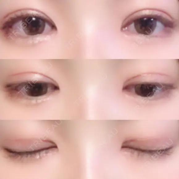 二重切開 / 目頭切開 / 眼瞼下垂（切開） / その他（目元） / 上まぶたの脂肪取り レアート整形外科 DAY 62 メイン用