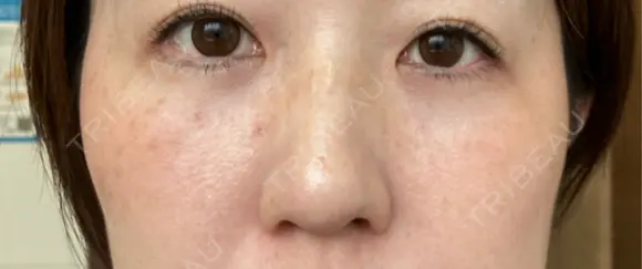 クマ治療 / 下まぶたの脂肪取り ROOTS Clinic AFTER メイン用