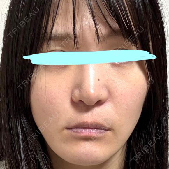 小鼻縮小（切開） / 鼻翼基部形成（貴族手術） 新宿ラクル美容外科クリニック 新宿院 DAY 58 メイン用