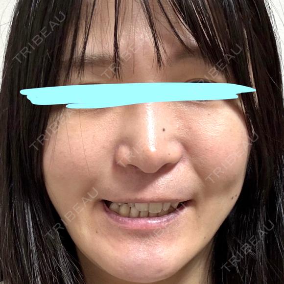 小鼻縮小（切開） / 鼻翼基部形成（貴族手術） 新宿ラクル美容外科クリニック 新宿院 DAY 58 メイン用