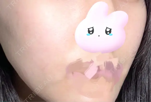 ヴァンパイアフェイシャル 東京美容クリニック 表参道本院 DAY 5 メイン用