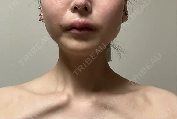 ボトックス（肩） ルラ美容クリニック 名古屋本院 DAY 6 メイン用