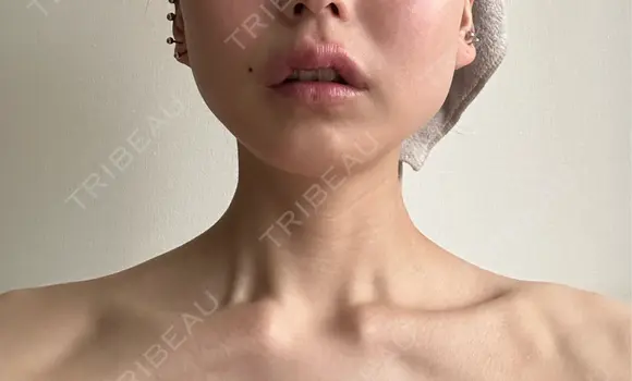 ボトックス（肩） ルラ美容クリニック 名古屋本院 DAY 7 メイン用