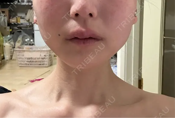 ボトックス（肩） ルラ美容クリニック 名古屋本院 DAY 8 メイン用