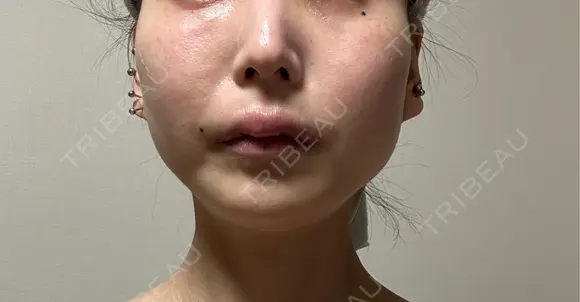 ボトックス（エラ・小顔） ルラ美容クリニック 名古屋本院 DAY 6 メイン用