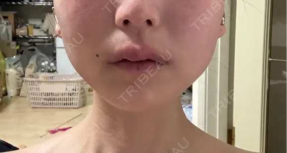 ボトックス（エラ・小顔） ルラ美容クリニック 名古屋本院 DAY 8 メイン用