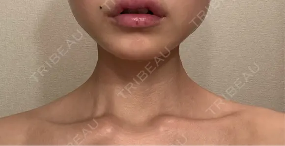 ボトックス（肩） ルラ美容クリニック 名古屋本院 DAY 3 メイン用