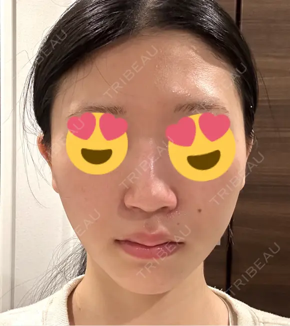 小鼻縮小（切開） くさのたろうクリニック DAY 28 メイン用