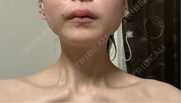 ボトックス（肩） ルラ美容クリニック 名古屋本院 AFTER メイン用