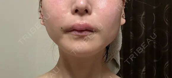 ボトックス（エラ・小顔） ルラ美容クリニック 名古屋本院 AFTER メイン用