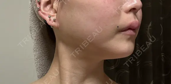 ボトックス（エラ・小顔） ルラ美容クリニック 名古屋本院 DAY 9 メイン用