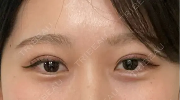 二重埋没 ルラ美容クリニック 神戸院 AFTER メイン用