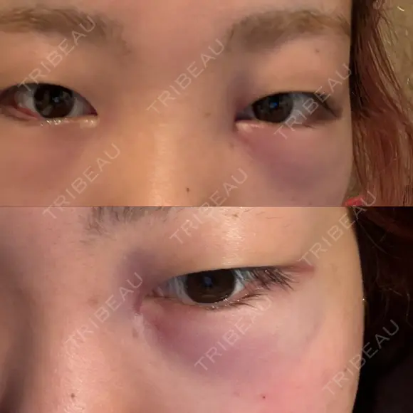 クマ治療 / ヒアルロン酸注入（目の下） PRISM Beauty Clinic 町田院 DAY 1 メイン用