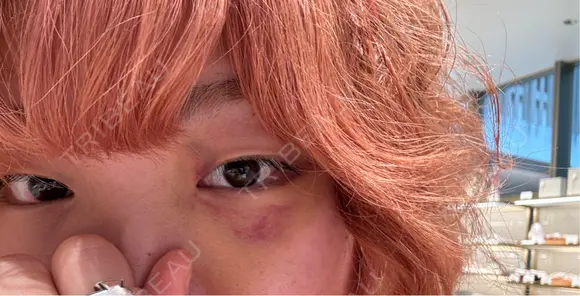 クマ治療 / ヒアルロン酸注入（目の下） PRISM Beauty Clinic 町田院 DAY 6 メイン用