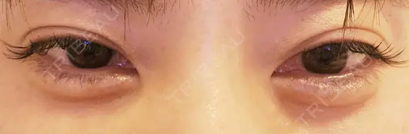 ヒアルロン酸注入（涙袋） ネビュラクリニック 東京錦糸町院 DAY 1 メイン用