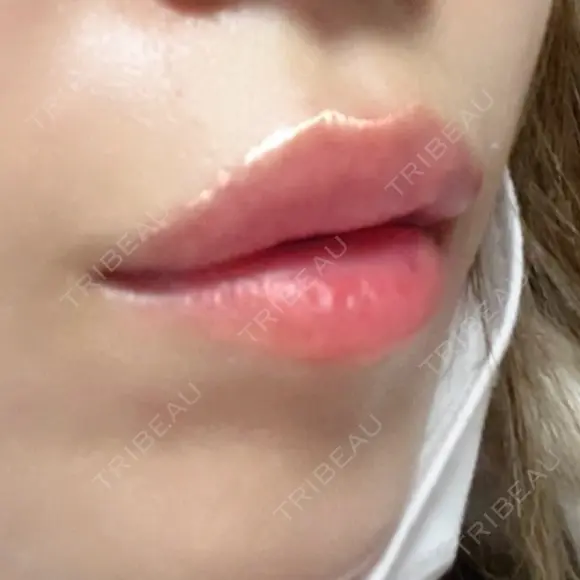 ヒアルロン酸注入（唇） / ヒアルロン酸注入（目の下） KIMI CLINIC 形成・美容外科 DAY 3 メイン用