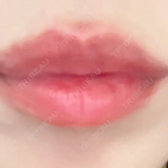 ヒアルロン酸注入（唇） / ヒアルロン酸注入（目の下） KIMI CLINIC 形成・美容外科 DAY 4 メイン用