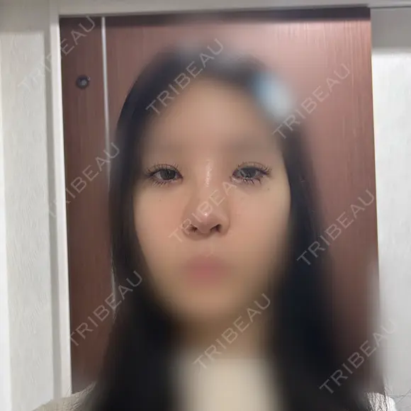 目頭切開 / 小鼻縮小（切開） / 鼻尖形成（非切開） アネシス美容クリニック DAY 7 メイン用