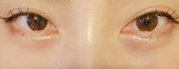 ヒアルロン酸注入（涙袋） ネビュラクリニック 東京錦糸町院 DAY 2 メイン用