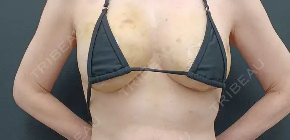 豊胸（脂肪注入） 湘南美容クリニック 吉祥寺院 AFTER メイン用