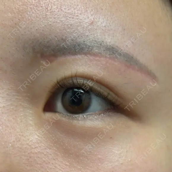 眉下切開 Barbie Clinic AFTER メイン用