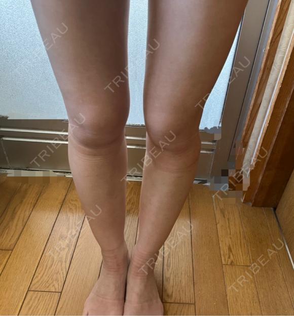 脂肪吸引（脚） / 豊胸（脂肪注入） オアシス美容外科 DAY 31 メイン用