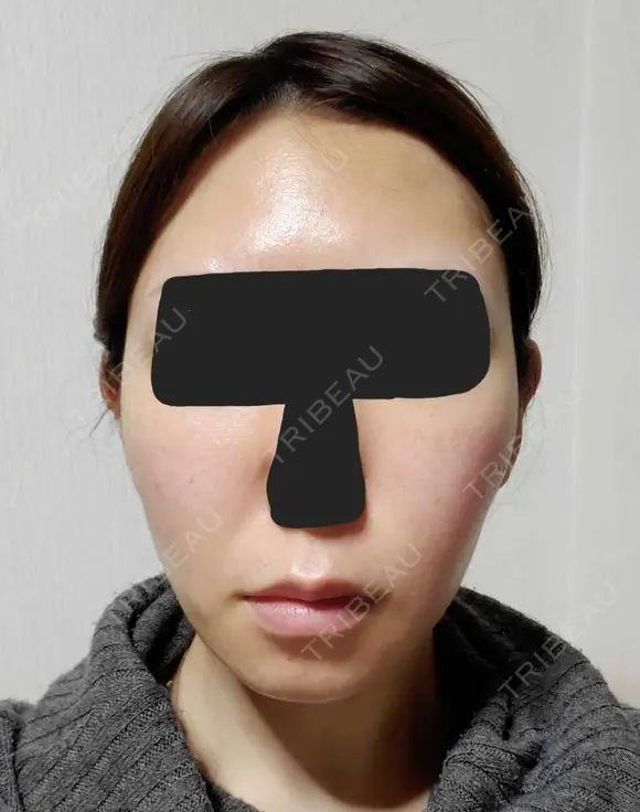 糸リフト / バッカルファット除去 / 脂肪吸引（顔） / ジョールファット除去 / ボトックス（エラ・小顔） アリエル美容クリニック 大宮院 DAY 97 メイン用